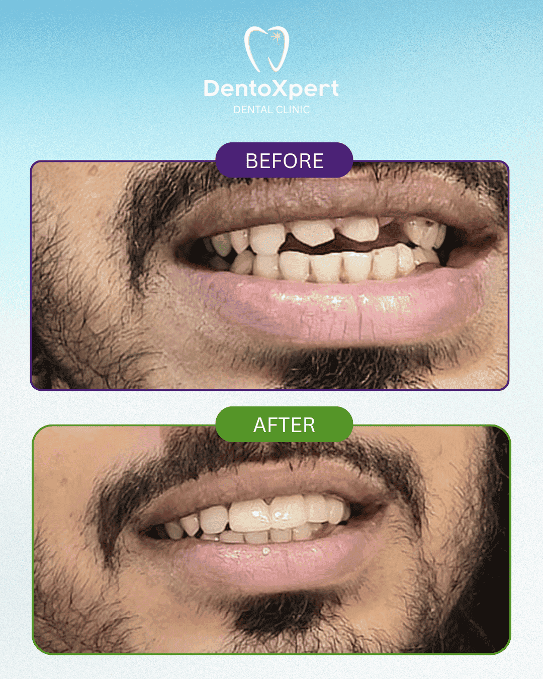 Before and after dental treatment result at DentoXpert Dental Clinic in Thane